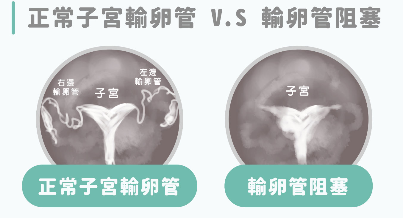 造影下 正常通常的输卵管和堵塞的输卵管对比