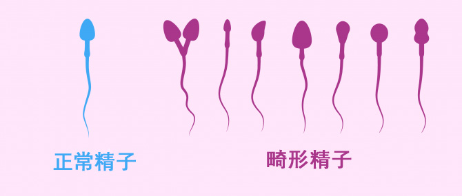 正常精子与各种畸形精子对比