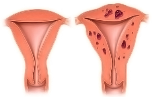 正常子宫与子宫腺肌症对比图 