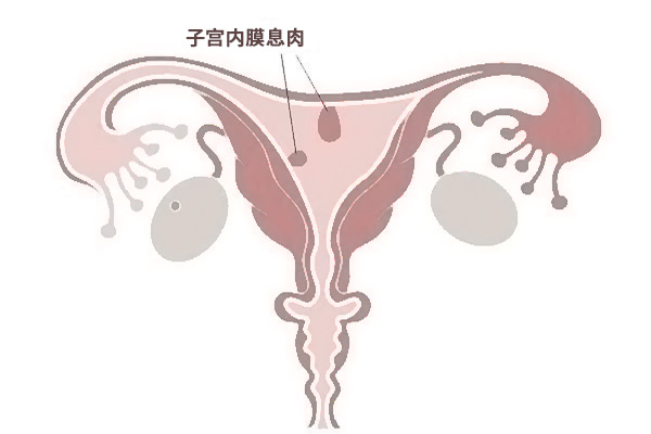 子宫内膜息肉